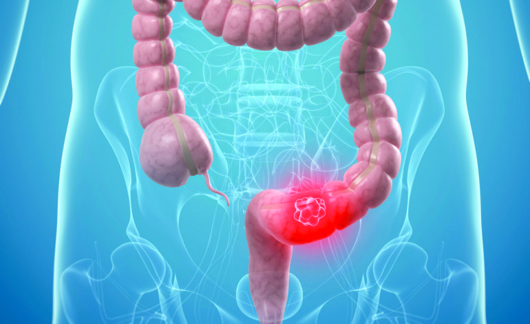 سرطان القولون يمكن تجنّبه بخمس طرق بسيطة