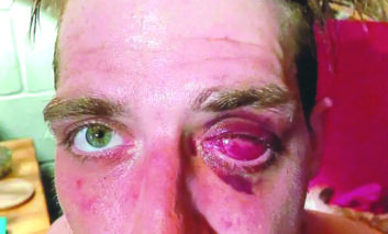 تعويضات بأكثر من أربعة ملايين دولار لرجل فقد إحدى عينيه على يد شرطة بلدة كلينتون