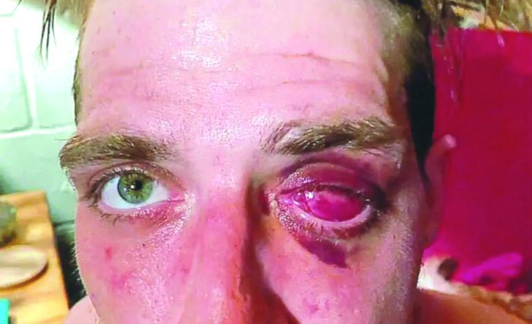 تعويضات بأكثر من أربعة ملايين دولار لرجل فقد إحدى عينيه على يد شرطة بلدة كلينتون